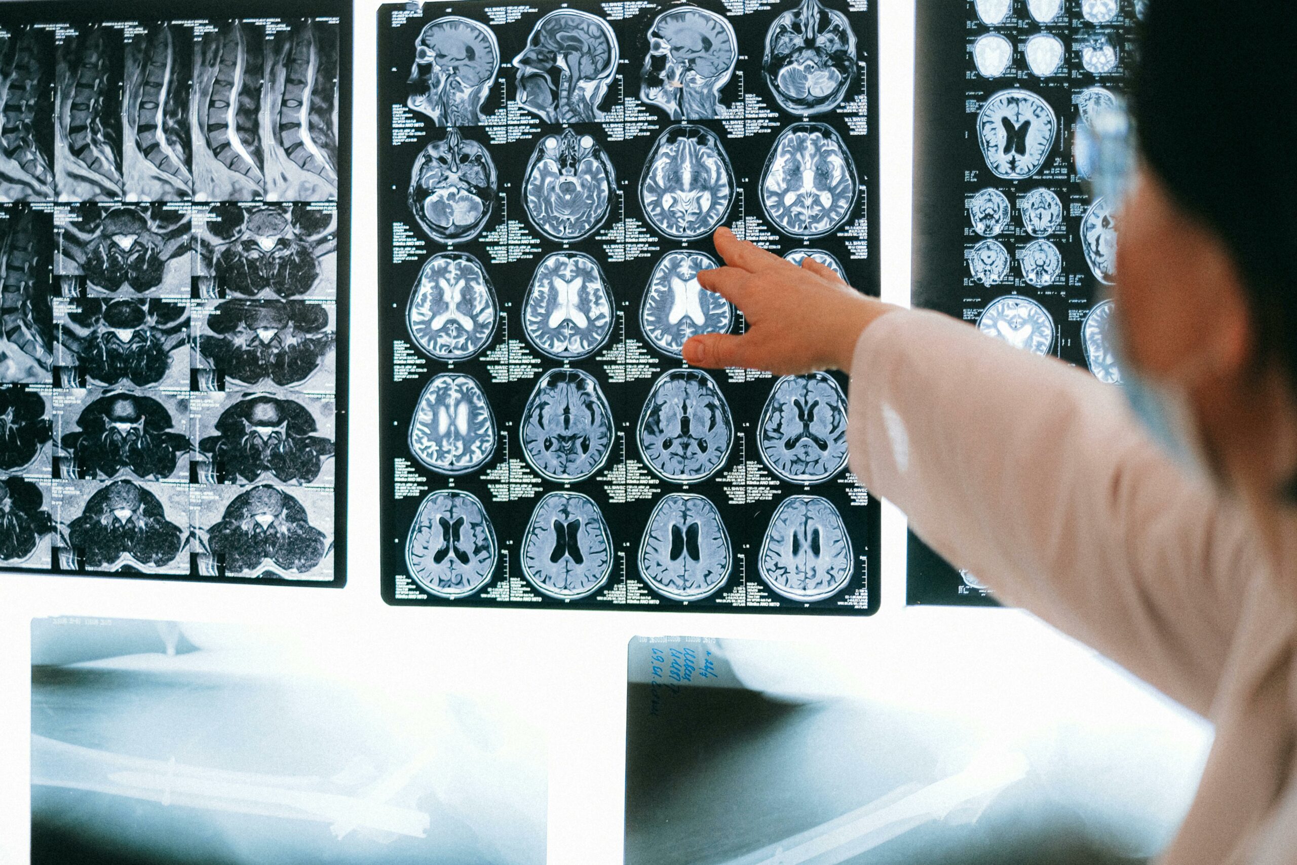 جایزه HDBuzz ۲۰۲۵: MR-«چرا» اینطور احساس میکنم؟ چگونه MRI به ما کمک میکند بفهمیم چرا افراد مبتلا به HD گاهی از علائم خود آگاه نیستند
